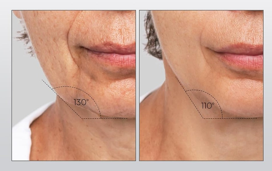 Opal Face Lifting &amp; Anti-Aging
